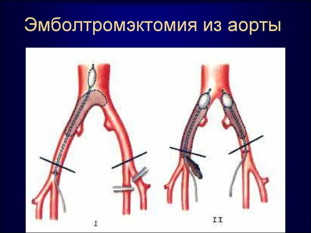 Острая артериальная ишемия. Эмболия бифуркации аорты. Тромбоз бифуркации аорты. Острая артериальная непроходимость. Эмболэктомия бифуркации аорты.