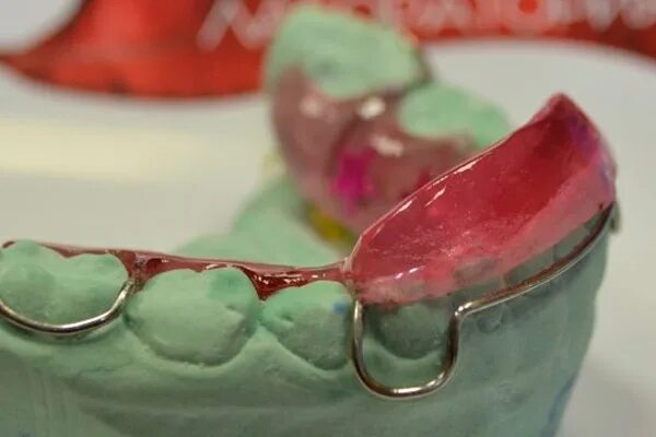 функционально действующие ортодонтические аппараты. пластинка на верхнюю челюсть с накусочной площадкой. аппарат шварца с литой наклонной плоскостью (. аппарат брюкля-рейхенбаха. наклонная плоскость ортодонтия.