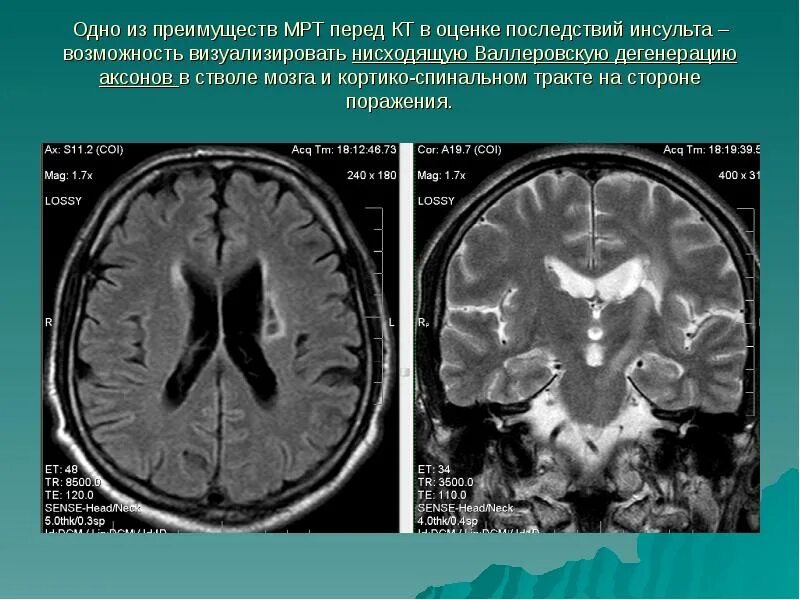 Мрт мозга опасно. Валлеровская дегенерация головного мозга-. Валлеровская дегенерация мрт. Последствия инсульта на мрт. Инсульт в стволе мрт.