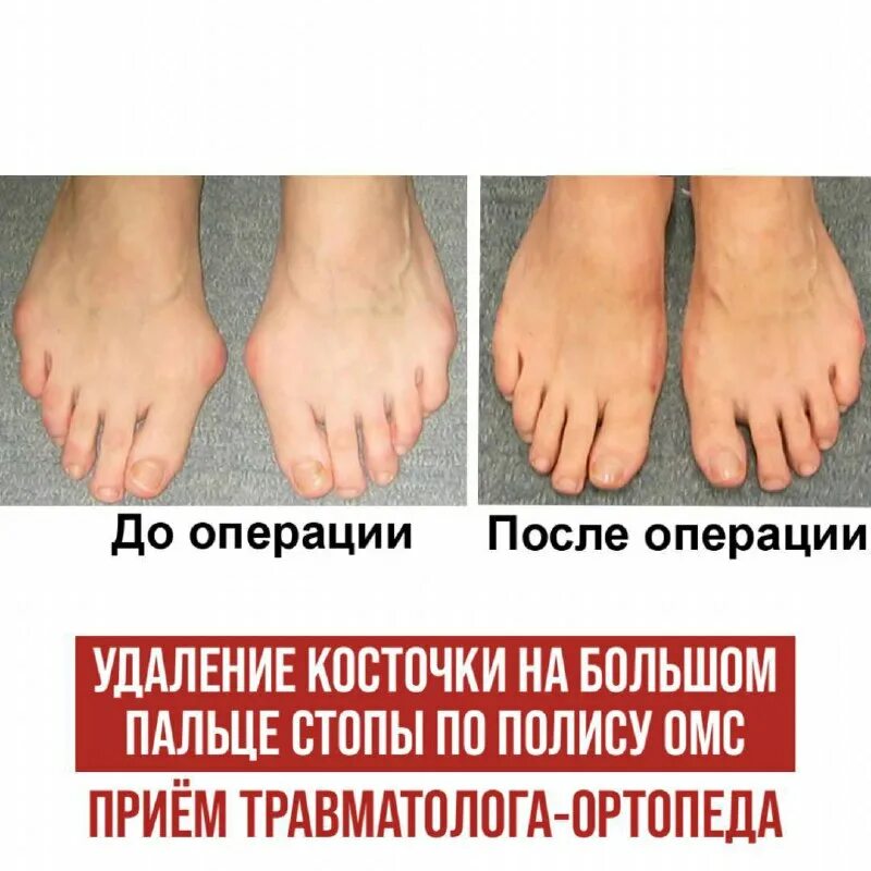 Удаление косточек на ногах по омс. Удаление косточек на ногах по омс. Операция на косточке большого пальца. Удаление косточек на ногах по омс. Удаление косточек на ногах по омс.