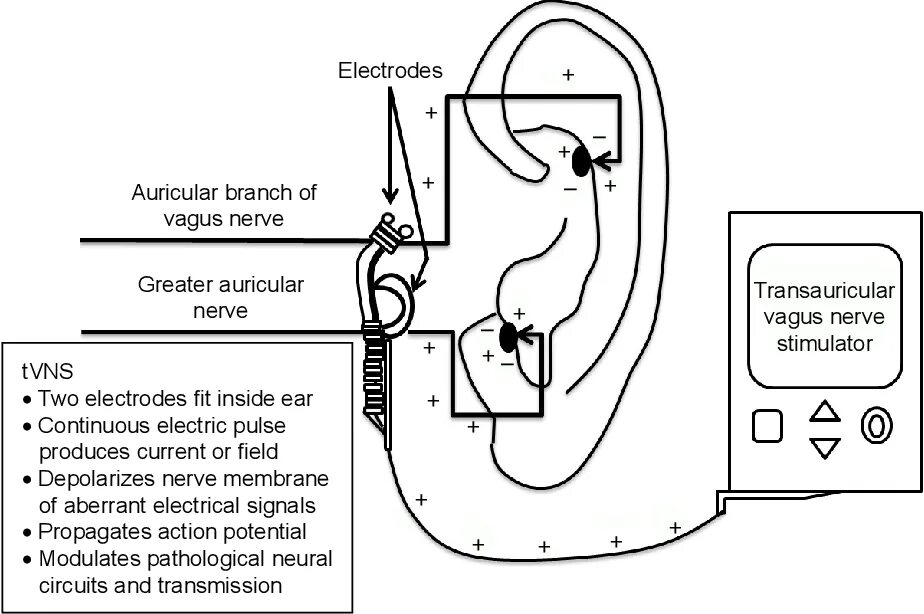 Стимулятор блуждающего нерва. Вагус стимулятор блуждающего нерва. Стимуляция блуждающего нерва прибор. Чрескожная электрическая стимуляция блуждающего нерва. Блуждающий нерв электростимуляция.