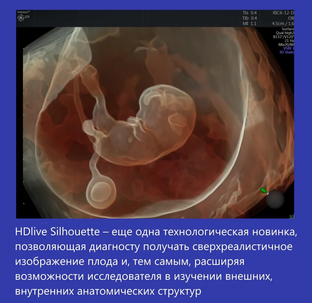 Беременна от 48 мужское. Voluson e10. Ge Voluson e10.