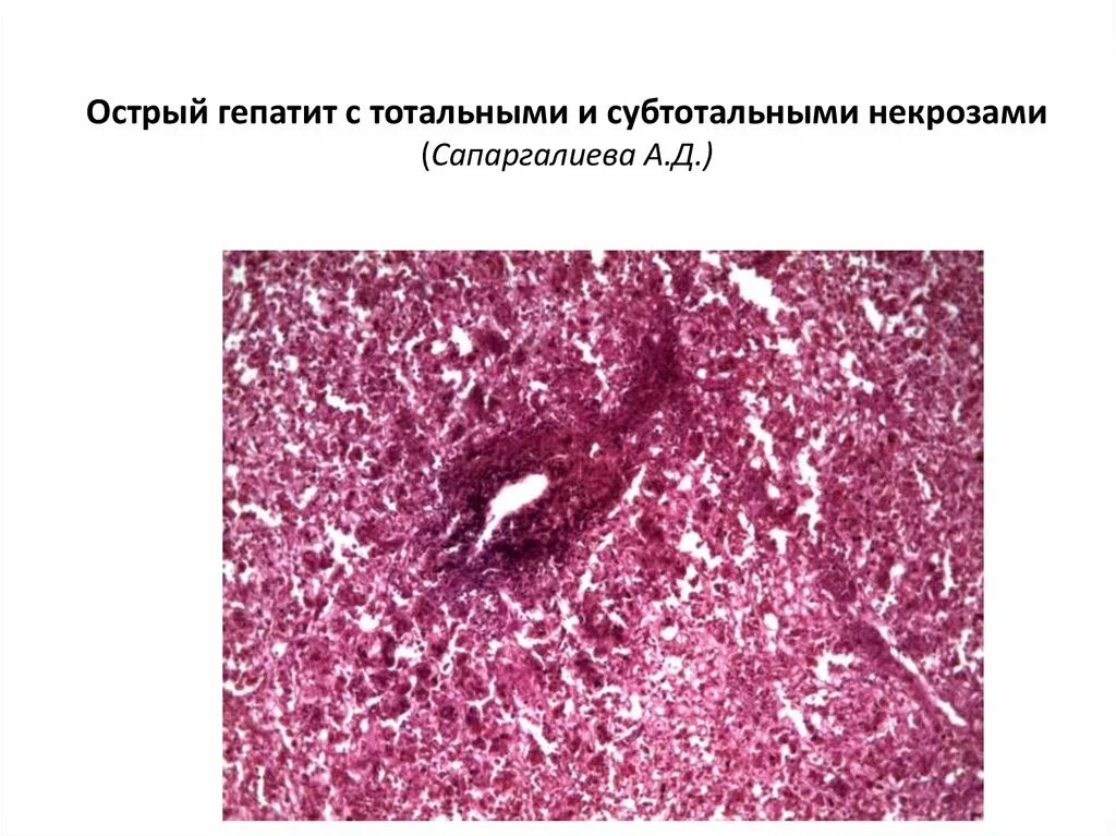 Вирусный гепатит гистология. Фульминантный гепатит патанатомия. Острый фульминантный гепатит. Острый вирусный гепатит микропрепарат.