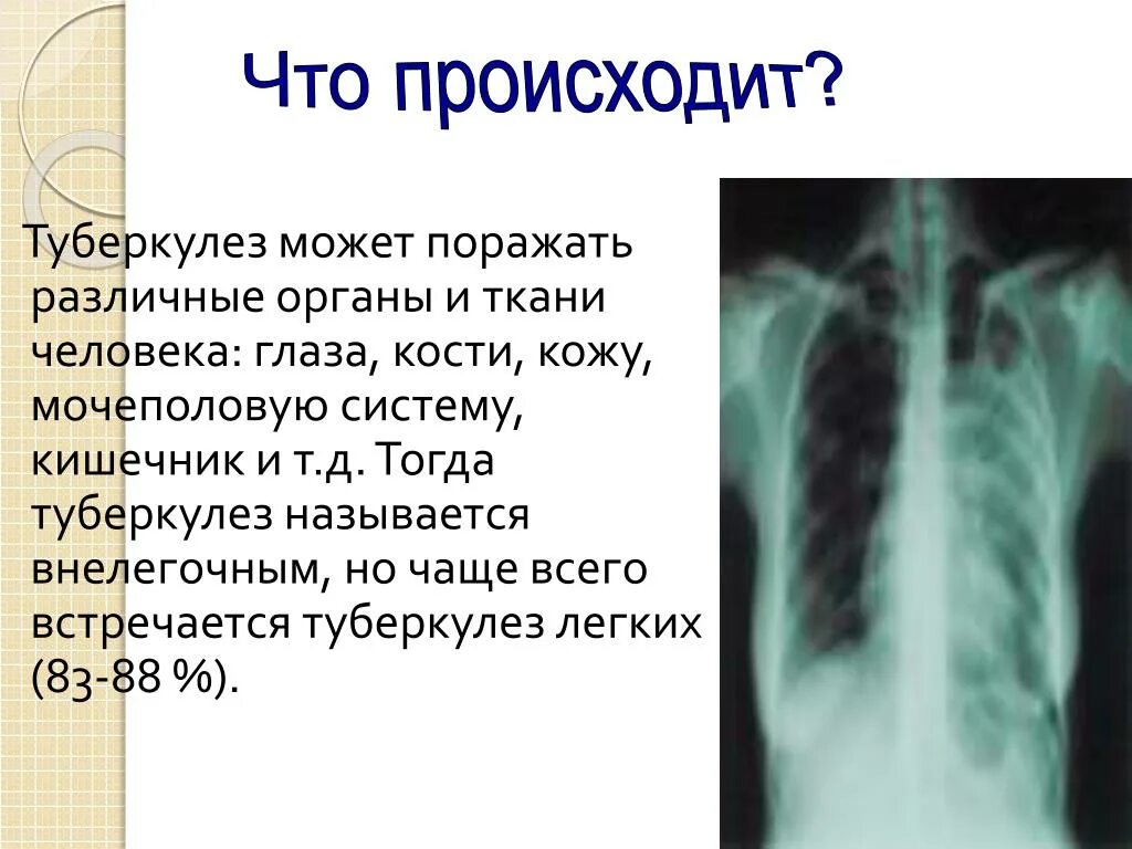 Поражаемые органы туберкулеза. Внелегочный туберкулез презентация. Внелегочные формы туберкулеза. Туберкулез легких презентация. Презентация на тему туберкулез.