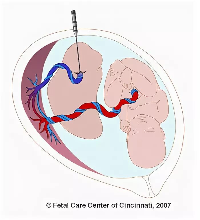 Фетальная хирургия. Обратная артериальная перфузия. Фето фетальный трансфузионный синдром. Синдром обратной артериальной перфузии у плода.