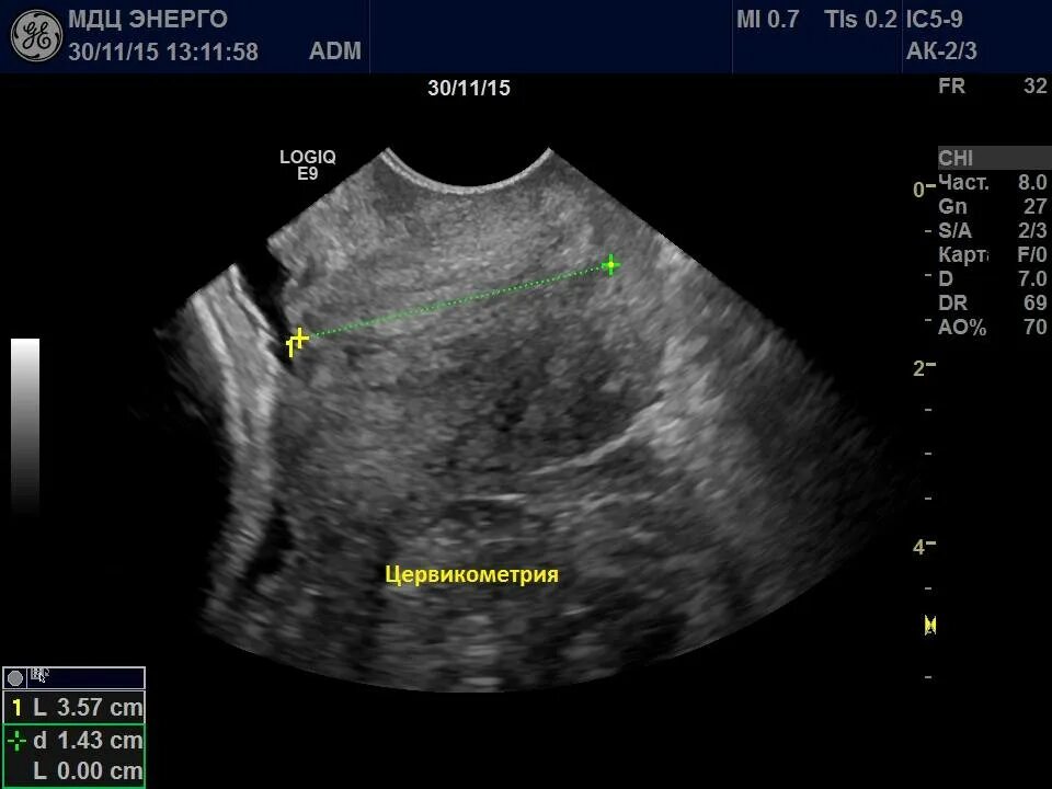 14 недель шейка. Измерение шейки матки на УЗИ. УЗИ шейки матки цервикометрия. Ультразвуковое исследование шейки матки УЗИ-цервикометрия.