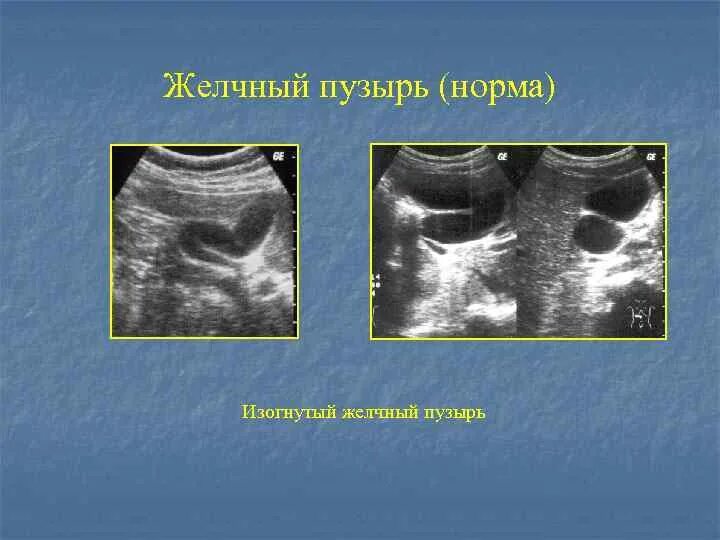 S образный желчный пузырь УЗИ. Перегиб желчного пузыря на УЗИ. Изгиб желчного пузыря УЗИ. S образный Перегиб желчного пузыря. Желчный изгиб у ребенка