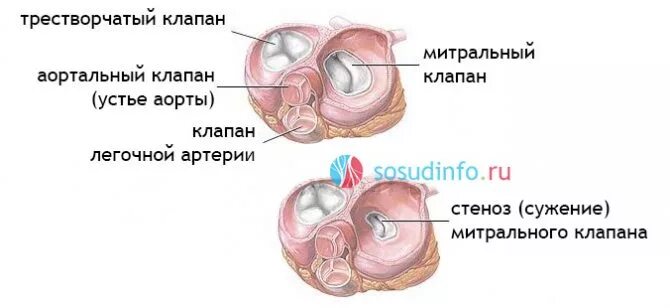 Митральный аортальный стеноз. Стеноз митрального клапана операция. Митральный клапан и клапан аорты. Аортальный и митральный стеноз. Стеноз митрального клапана сердца.