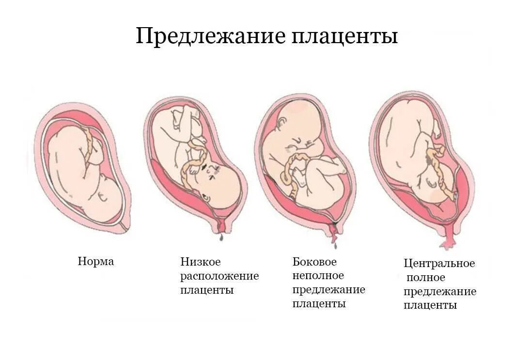 Полное предлежание форум. Плацента краевое предлежание плаценты. Центральное прикрепление плаценты. Типы прикрепления плаценты. Место прикрепления к плаценте центральное.