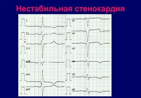 Стенокардия на экг
