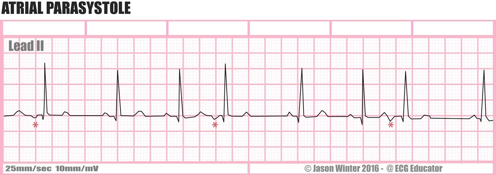 Брадикардия как поднять пульс. Синусовая брадикардия на экг. sinus bradycardia ecg. брадикардия снимки. брадикардия фото.