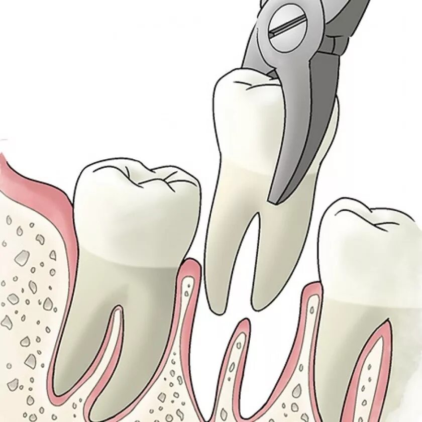 Вырывание зуба мудрости. Вырезание зуба мудрости. Фотоэффект законы фотоэффекта. Количество вырвать. Постановка брекетов после удаления зубов мудрости.