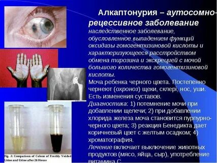 Постепенно заболевание