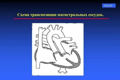Корригированная транспозиция сосудов