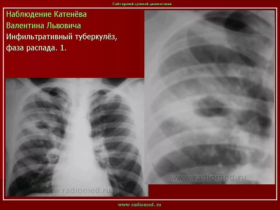 Фаза распада легких. Инфильтративный туберкулез фаза обсеменения. Фаза обсеменения туберкулеза на рентгене. Инфильтративный туберкулез легких s1-2. Инфильтративный туберкулез легких в фазе распада кт.