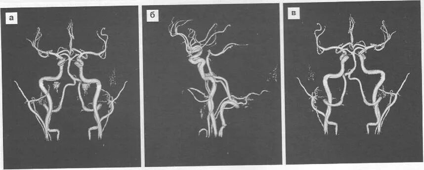 Интракраниальные артерии головного мозга. Гипоплазия позвоночной артерии. Гипоплазия позвоночной артерии мрт. Гипоплазия передней мозговой артерии. Гипоплазия артерии головного мозга.