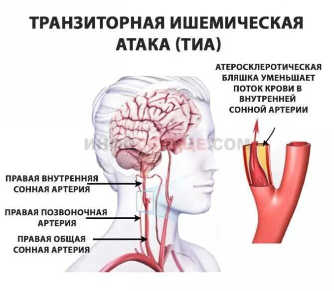 Причины ишемии мозга. Ишемический инсульт поражения артерий. Транзиторный ишемический инсульт. Транзиторная ишемическая атака головного мозга. Тиа и ишемический инсульт.