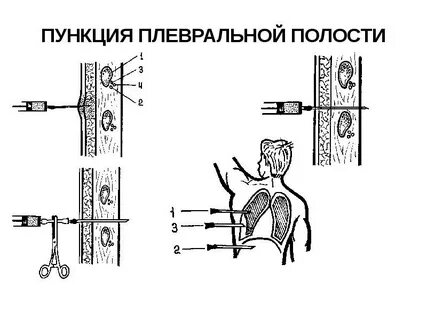 Осложнениями плевральной пункции являются