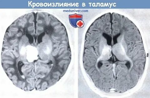 Кровоизлияние у детей