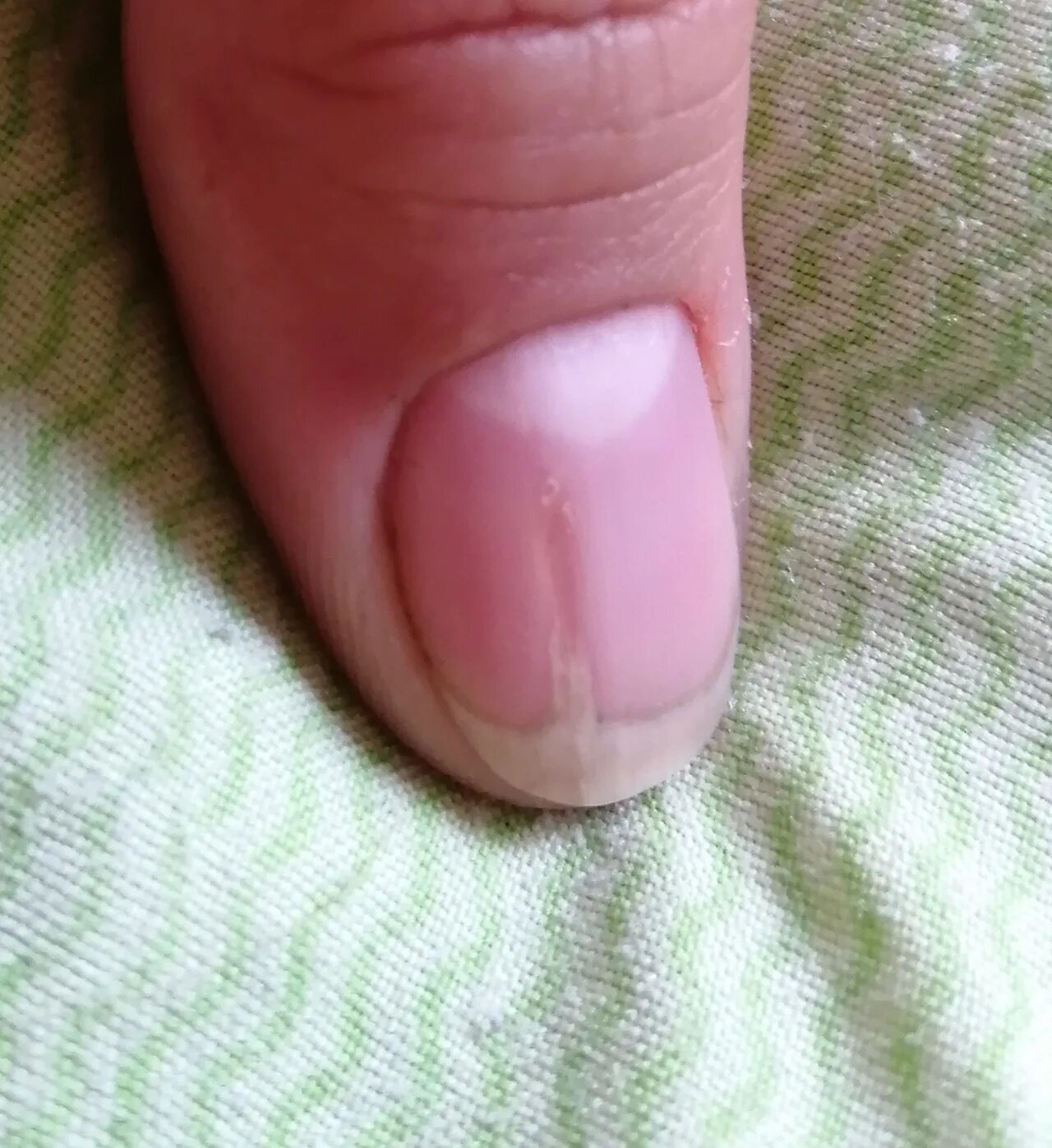 Почему на ногтях появляются продольные. Онихорексис трахионихия. Микотическая лейконихия. Поперечные полоски на ногтях. Продольные полосы на ногтях.