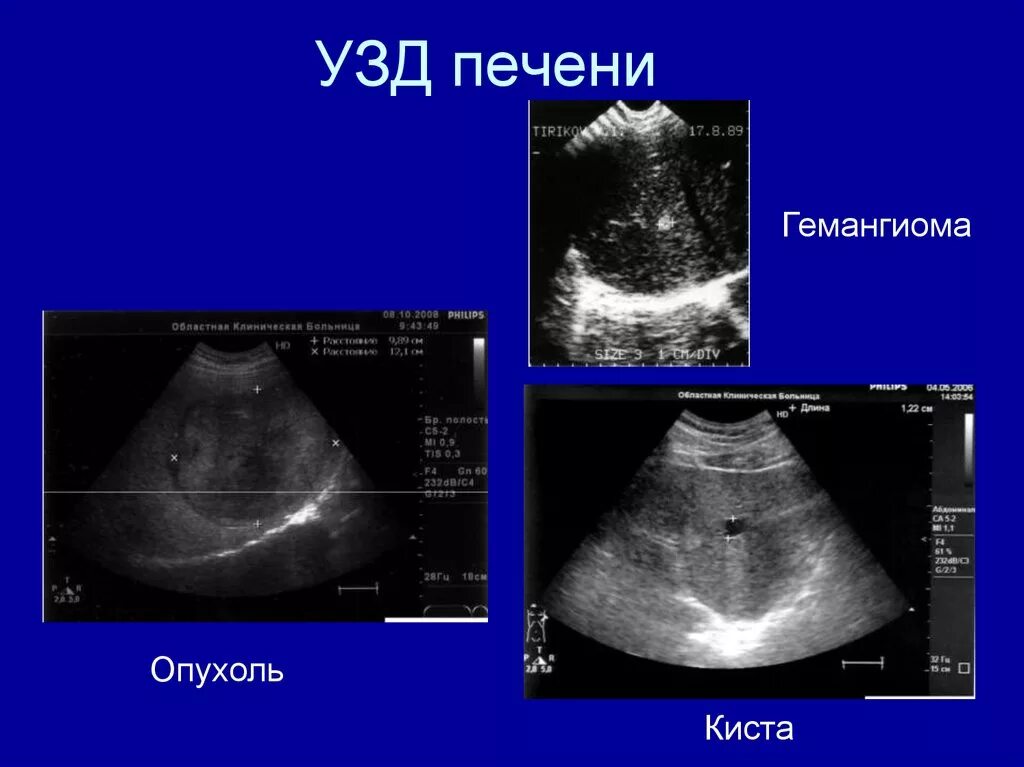 Очаговые гемангиомы печени. Объемные образования печени на УЗИ.