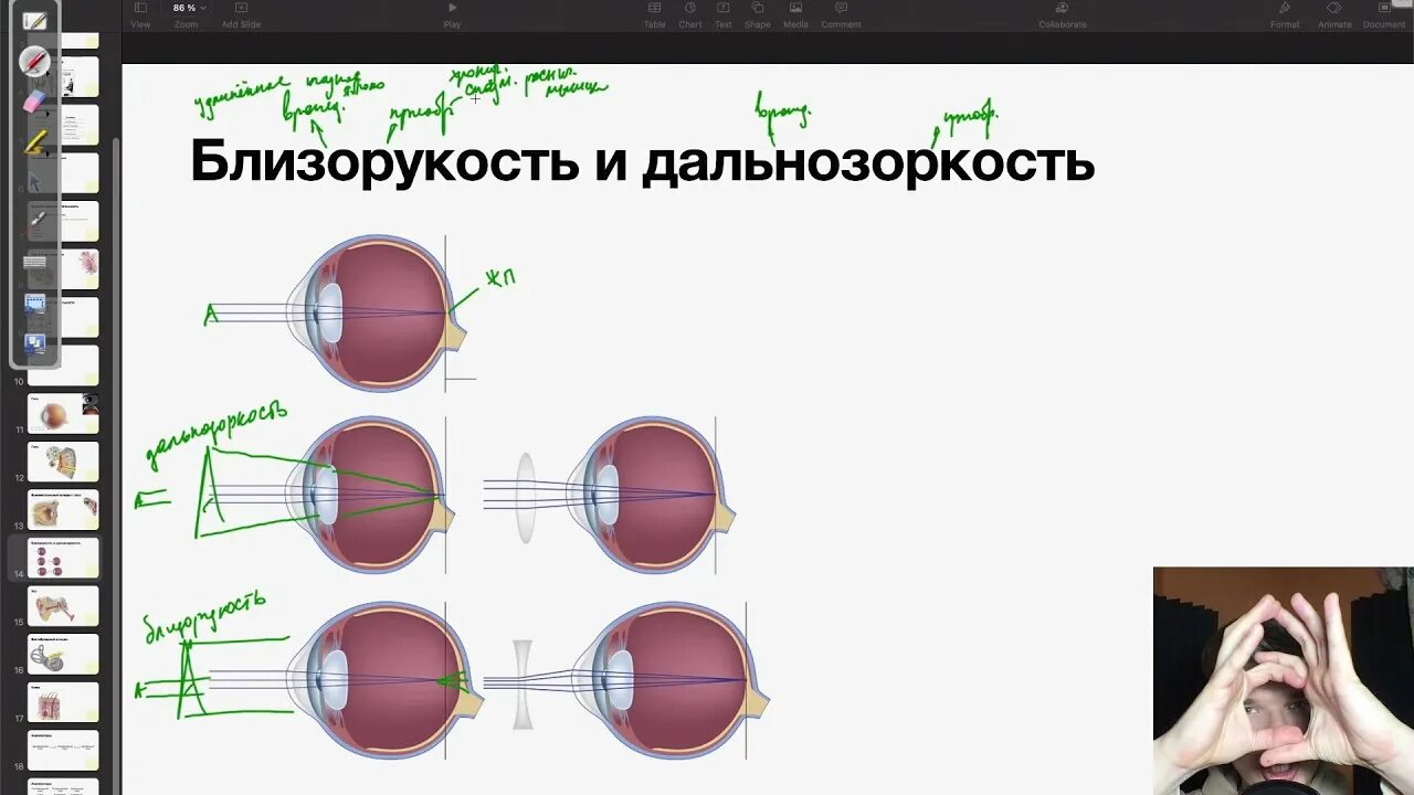 Близорукость и дальнозоркость. Близорукость и дальнозоркость биология. Дальнозоркость и близорукость ЕГЭ биология. Близорукость и дальнозоркость ЕГЭ. Миша страдает близорукостью а его брат дальнозоркостью