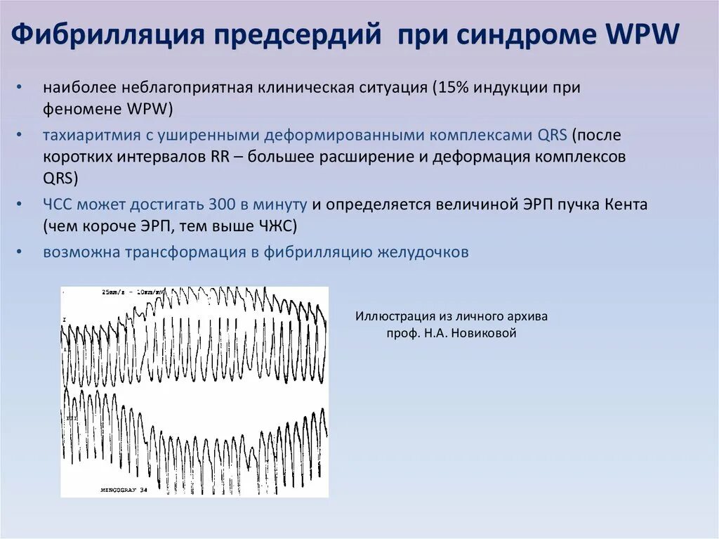 Фибрилляция предсердий на холтеровском мониторировании. Синдром фибрилляции предсердий. Брадиформа фибрилляции предсердий. Фибрилляция предсердий синдромы заболевания. Формы трепетания предсердий