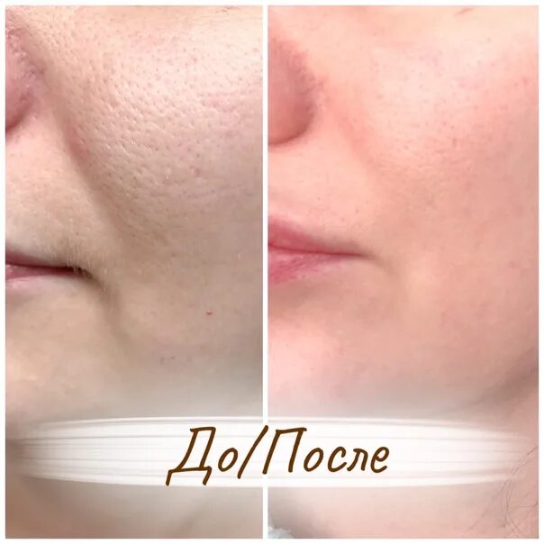 Пилинг для расширенных пор. Пилинг всесезонные беларуский. Пилинг для расширенных пор. Корейский пилинг для лица. Пилинг для лица.