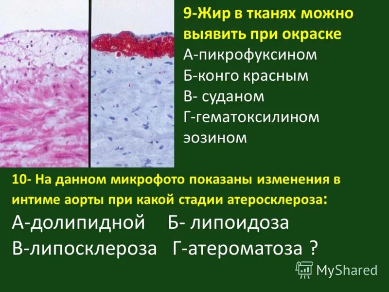 Проявления атеросклероза аорты. Атеросклероз аорты 1 степени. Атеросклероз аорты 1 степени. Атеросклероз грудного отдела аорты. Степень и стадия атеросклероза сосудов патанатомия.