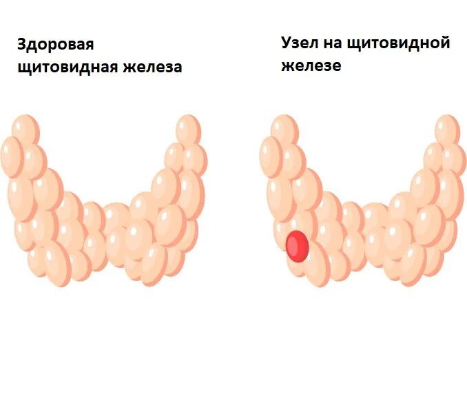 Одноузловой эутиреоидный зоб. Узловой коллоидный эутиреоидный зоб. Нетоксический многоузловой зоб. Диффузный многоузловой зоб. Многоузловой диффузный