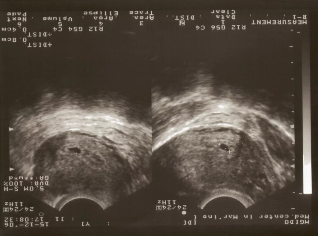 Снимок УЗИ 2-3 недели беременности. Снимок УЗИ на 4 неделе беременности. УЗИ 2-3 недели беременности фото. УЗИ беременных 3 недели.