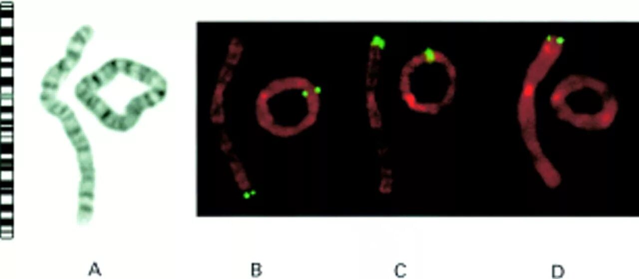 Дицентрическая хромосома. Кольцевая хромосома. Кольцевая хромосома генетика. Ring хромосомы. Кольцевая 4 хромосома