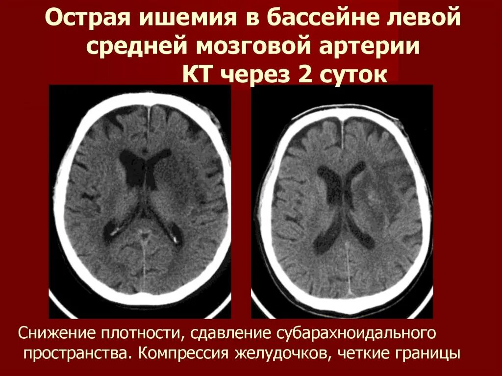 Бассейн левой средней мозговой артерии. Сужение субарахноидального пространства. Ишемический инсульт средней мозговой артерии. Что такое ишемический инсульт головного мозга