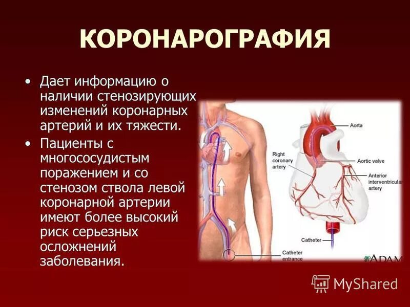 коронарные артерии на коронарографии. коронарография сосудов через руку. селективная коронарография. метод исследование коронарография. коронарные артерии на коронарографии.