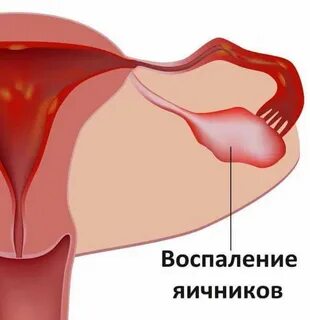 Спазмы яичников