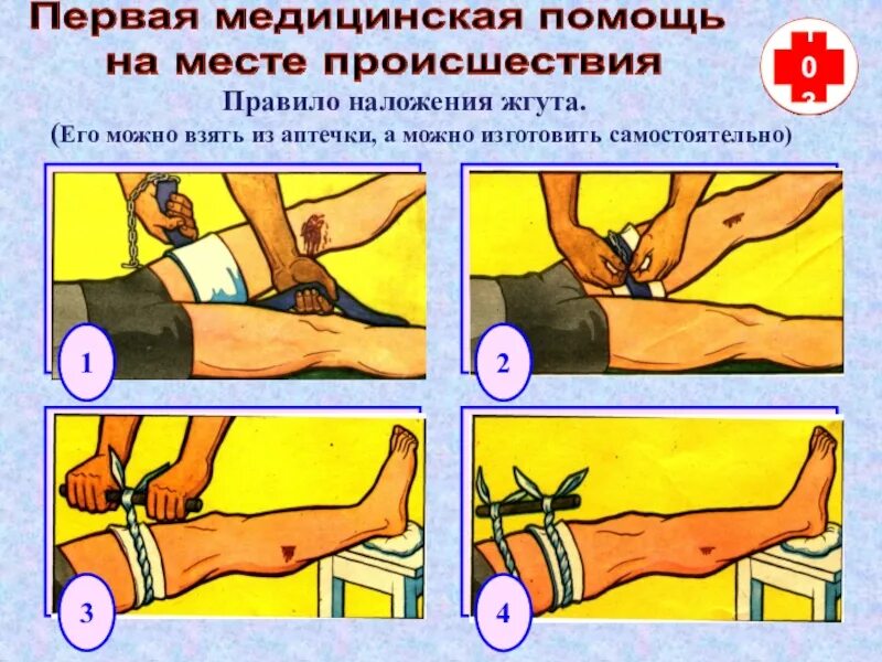 Какие ошибки при наложении жгута. Порядок накладывания жгута. Правила наложения жгута. Правило наложение жгута. Наложение кровоостанавливающего жгута.