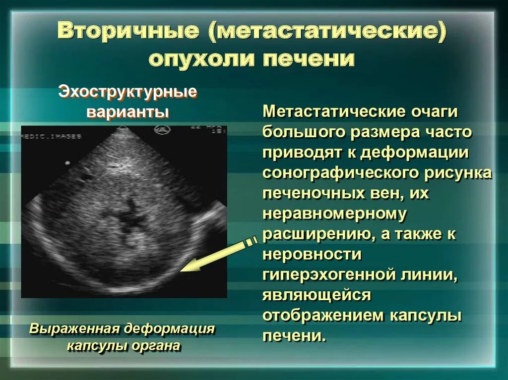 Образование в правой доле печени. Вторичные (Метастатические) опухоли печени. Образования печени на УЗИ. Доброкачественные и злокачественные опухоли печени. Объемные образования печени.