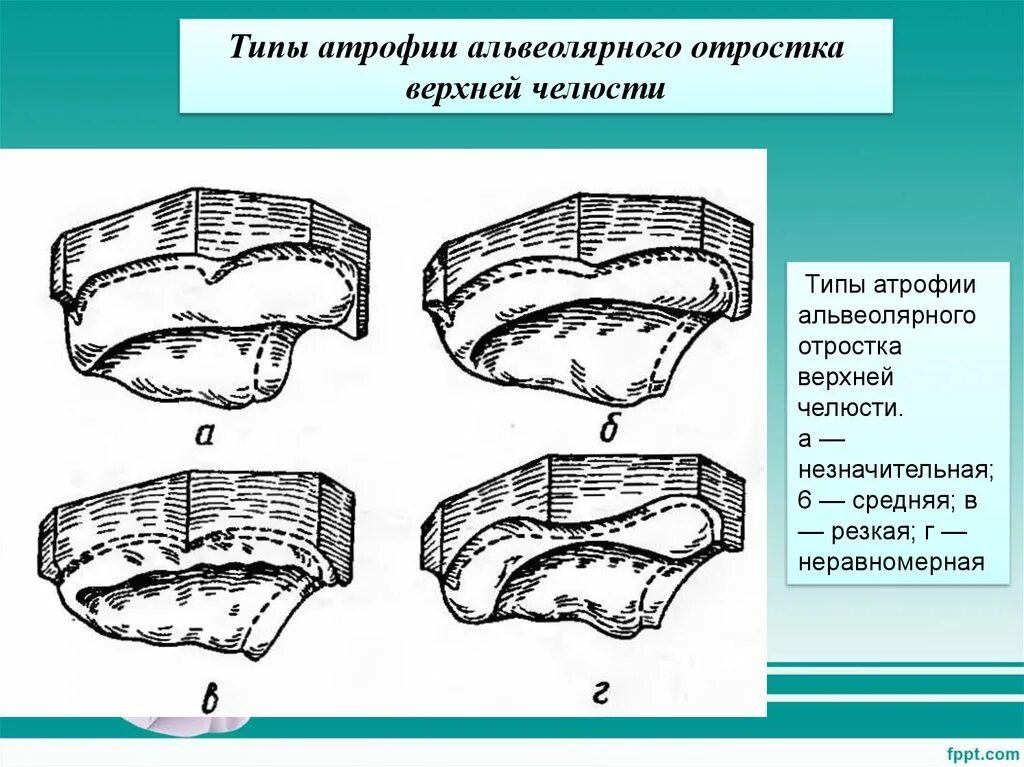 Оксман классификация беззубых челюстей. Классификация атрофии беззубых челюстей верхней челюсти. Топографические особенности беззубых челюстей. Классификация альвеолярных отростков верхней челюсти.