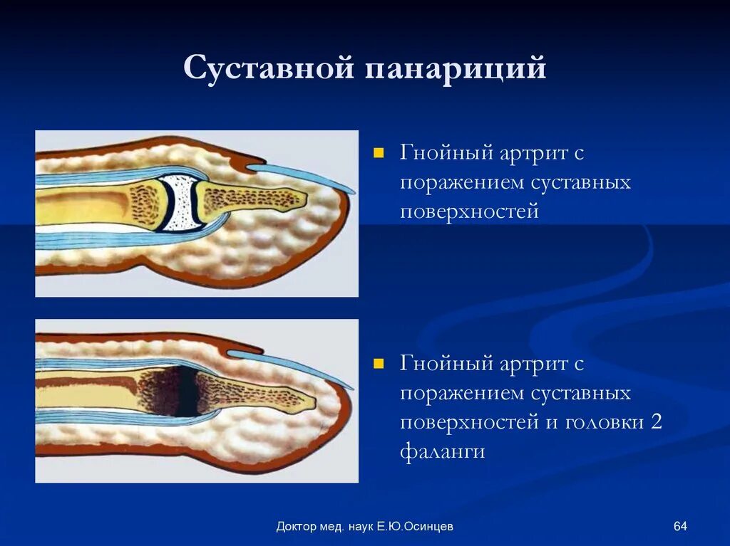Гистома