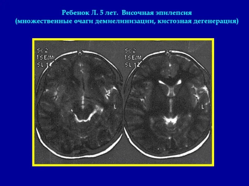 Приступы височной эпилепсии. Множественные очаги демиелинизации. височная эпилепсия. височно долевая эпилепсия. очаг височной доли мозга.