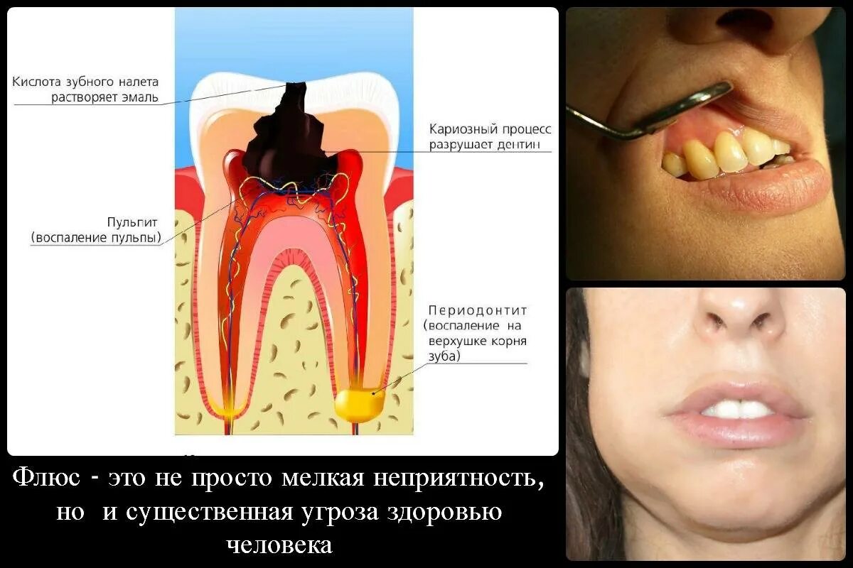 Может ли зубная боль пройти сама. Может ли зубная боль пройти сама