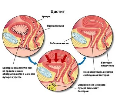 Гнойный цистит