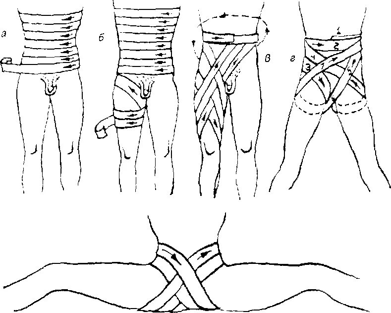 Бедренная перевязка. Повязки на область живота и таза десмургия. Повязка при переломе тазобедренного сустава. Переломы бедренной кости десмургия. Повязка на бедро десмургия.