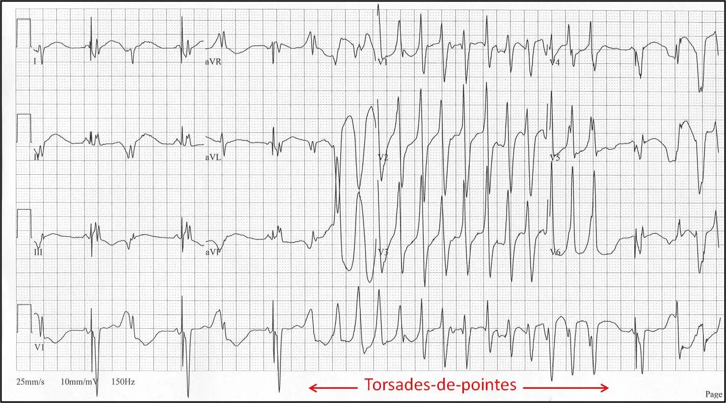Тахикардия у ребенка 10 лет. Torsades de pointes экг. torsades de pointes тахикардия. torsade de pointes аритмия. аритмии по типу torsades de pointes.