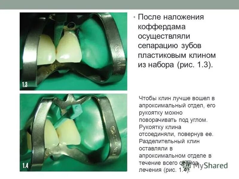 Зуб чувствителен после лечения. Коффердам (стоматология). Наложение коффердама в стоматологии. Коффердам на передних зубах.