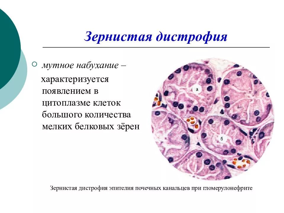 Микроскопические изменения зернистая дистрофия. Зернистая дистрофия эпителия канальцев почки макропрепарат. Зернистая белковая дистрофия микроскопия. Зернистая дистрофия микроскопия.