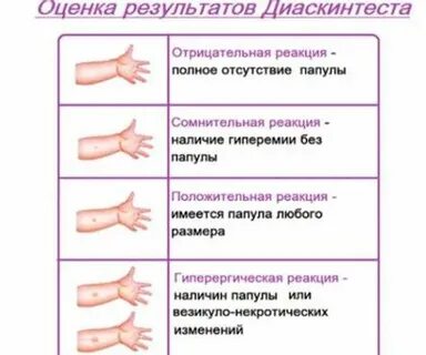 Диаскинтест безопасен