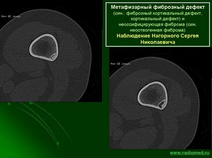 Фиброзно дефект