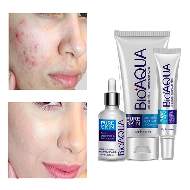 Акне реклама. Девушка с чистым лицом. Cares acne skin care. Девушка с проблемной кожей. Cares acne skin care.
