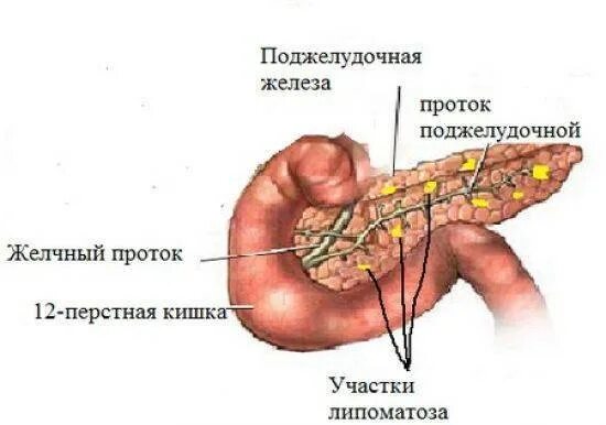 Фиброзные изменения поджелудочной